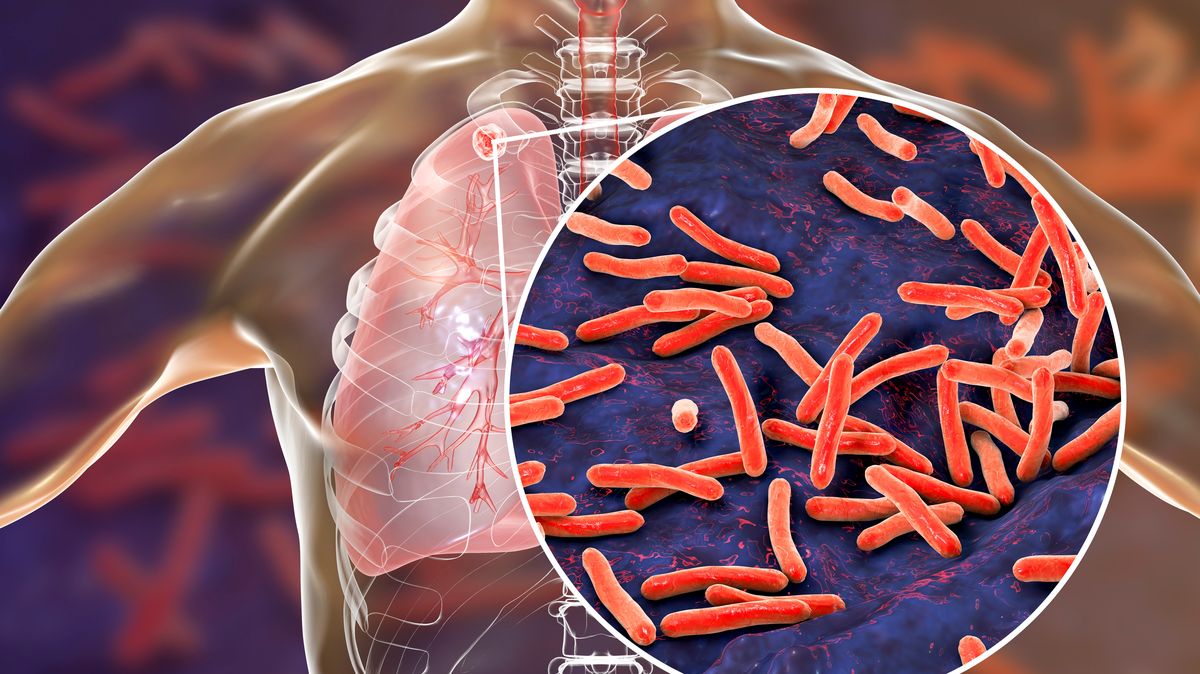 WHO: Tuberkulóza sílí, na vině je i pandemie covidu-19